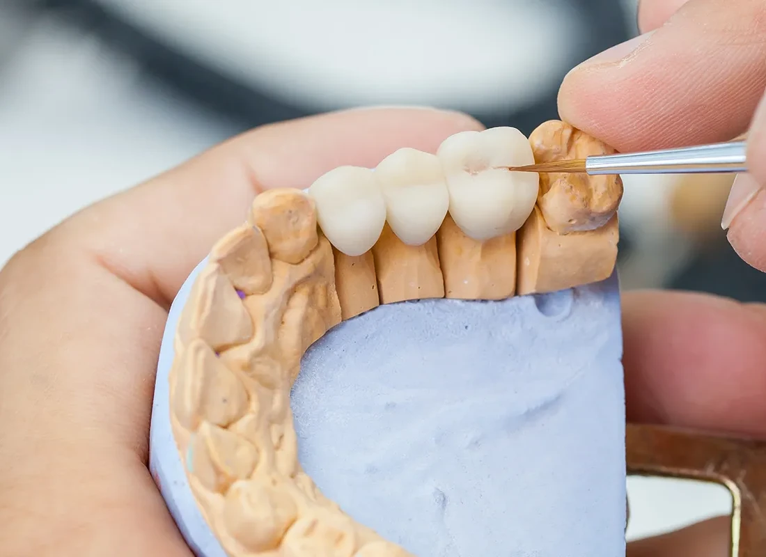 What is Dental Bridge