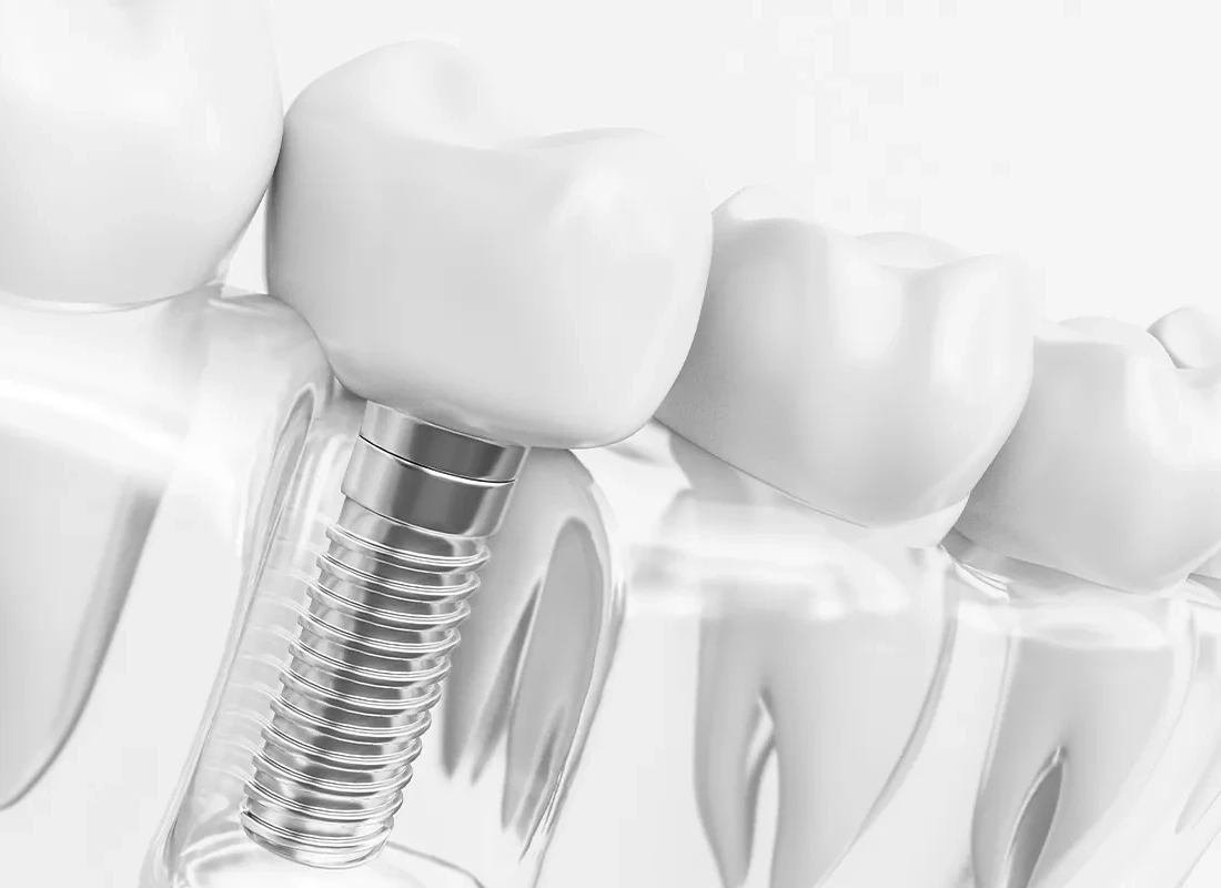 Dental implant options in Rancho Santa Margarita, CA