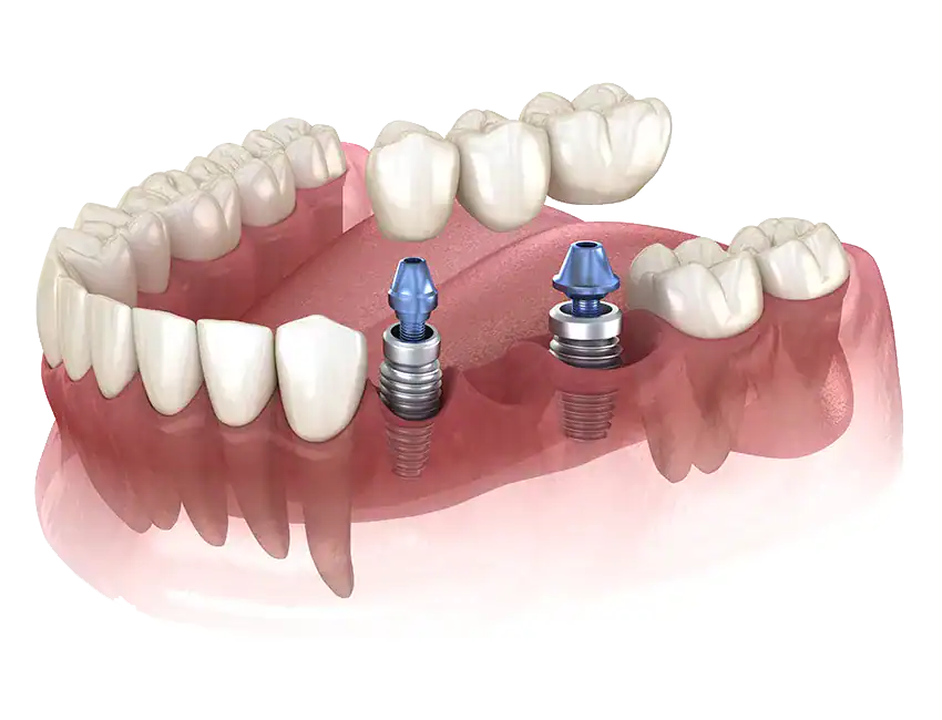 Implant-Supported Bridges