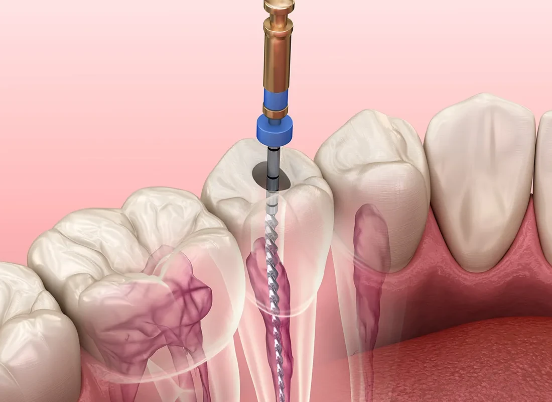 What is Root Canal Treatment