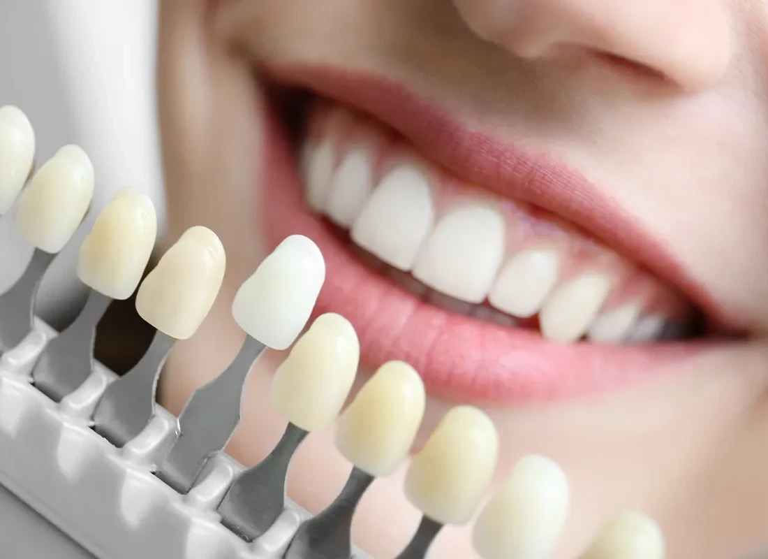 What is Internal Tooth Bleaching