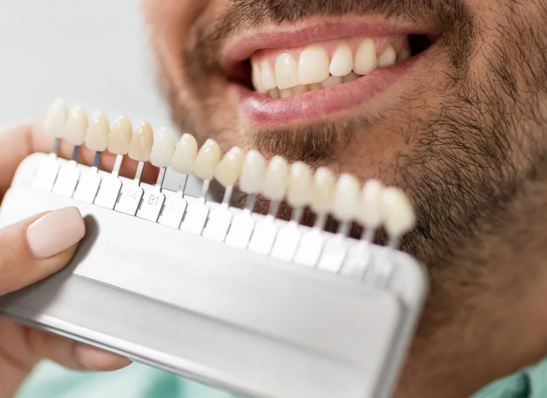 What is Teeth Whitening