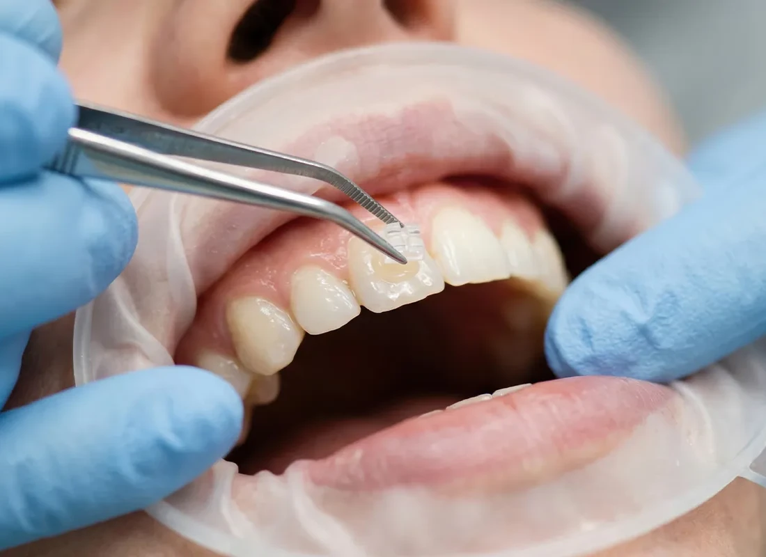 What is Cosmetic Bonding