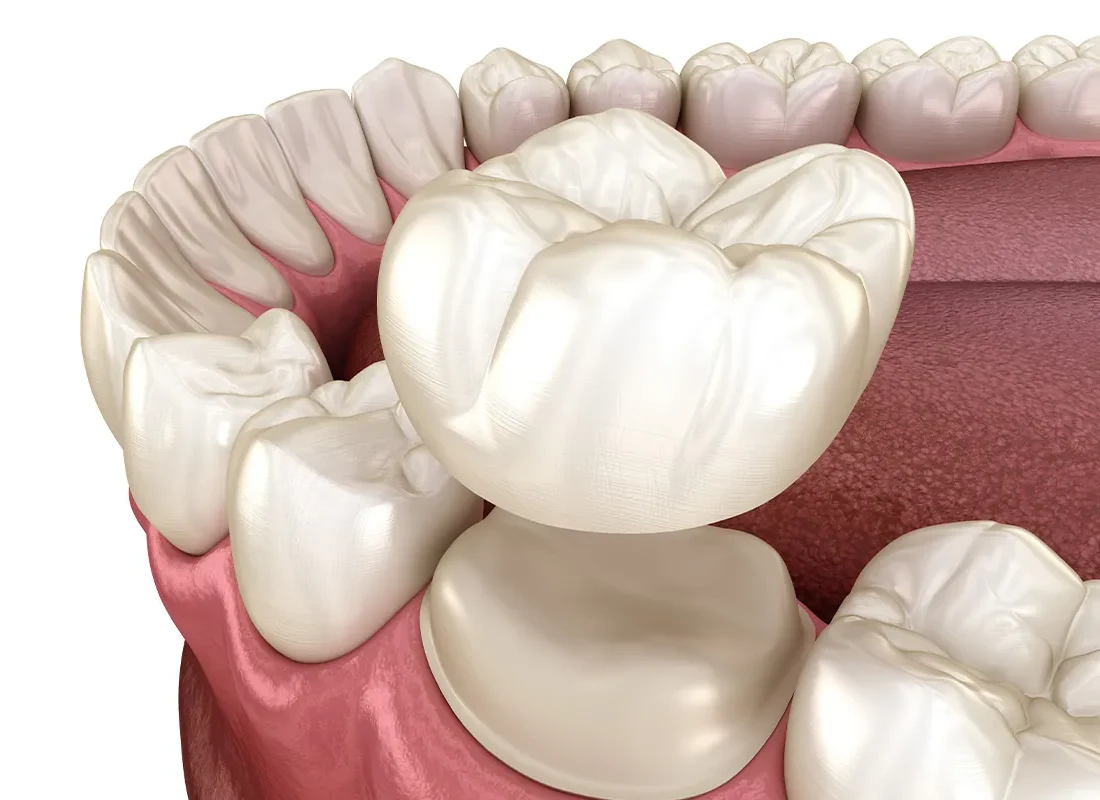 What is Crown Lengthening