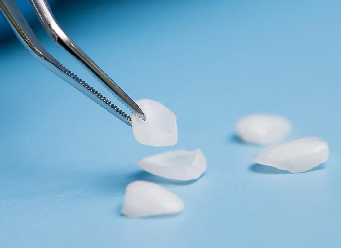 What is Lumineers and No-Prep Veneers