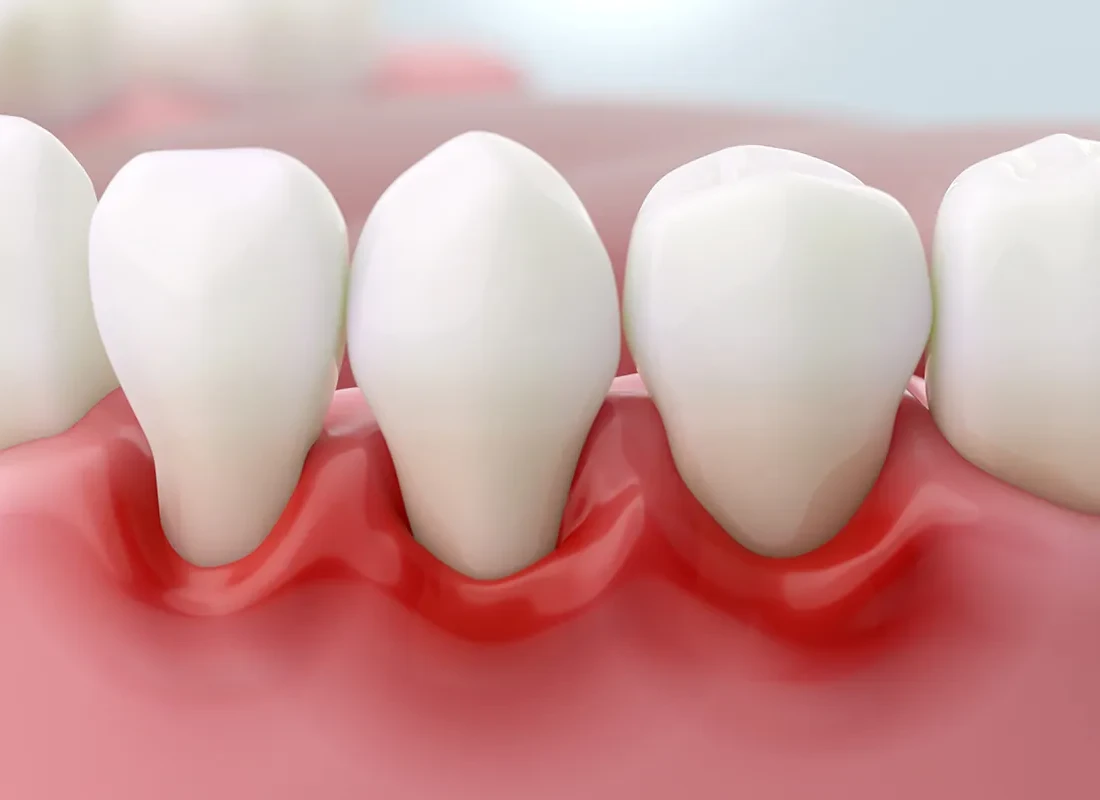 What is Pocket Reduction Surgery