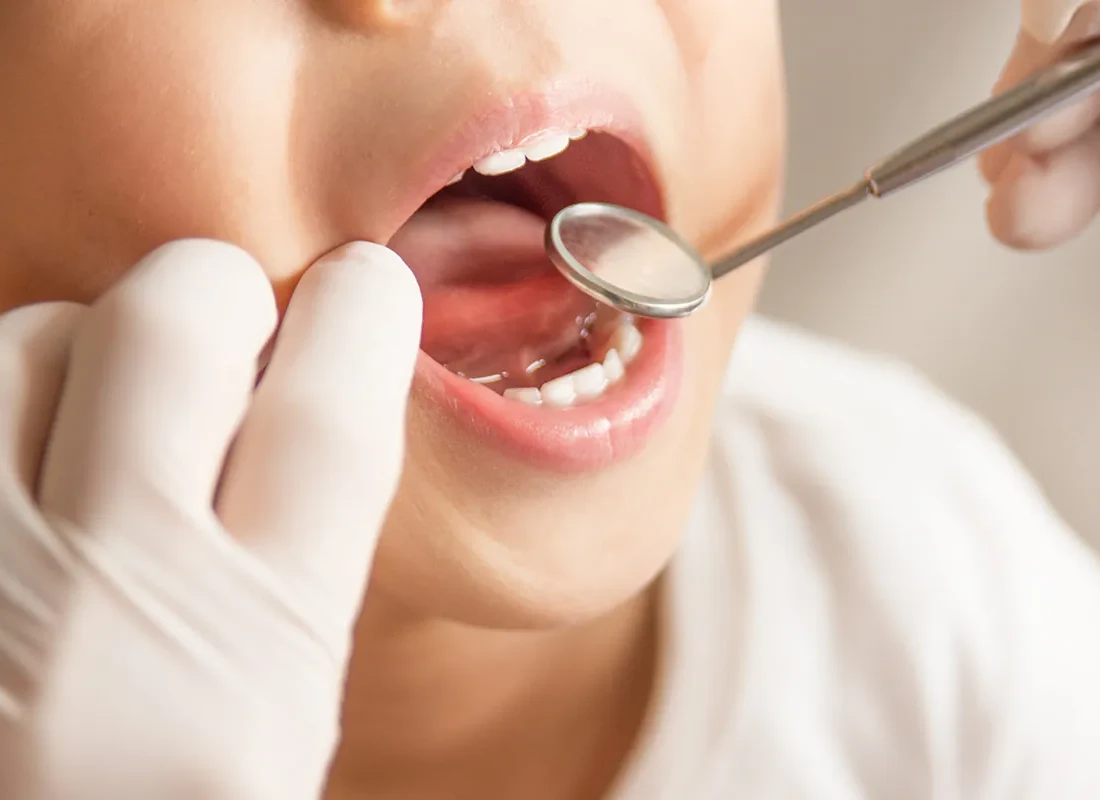 What is Laser Frenectomy