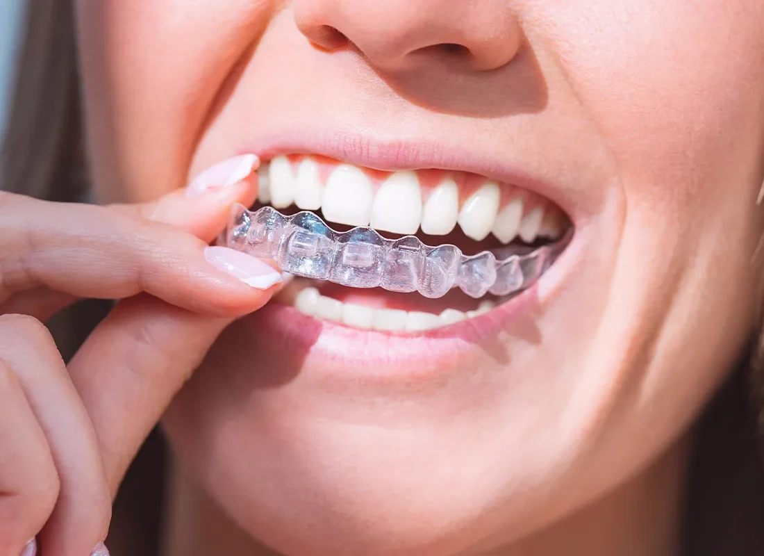 What is Mouth Guards