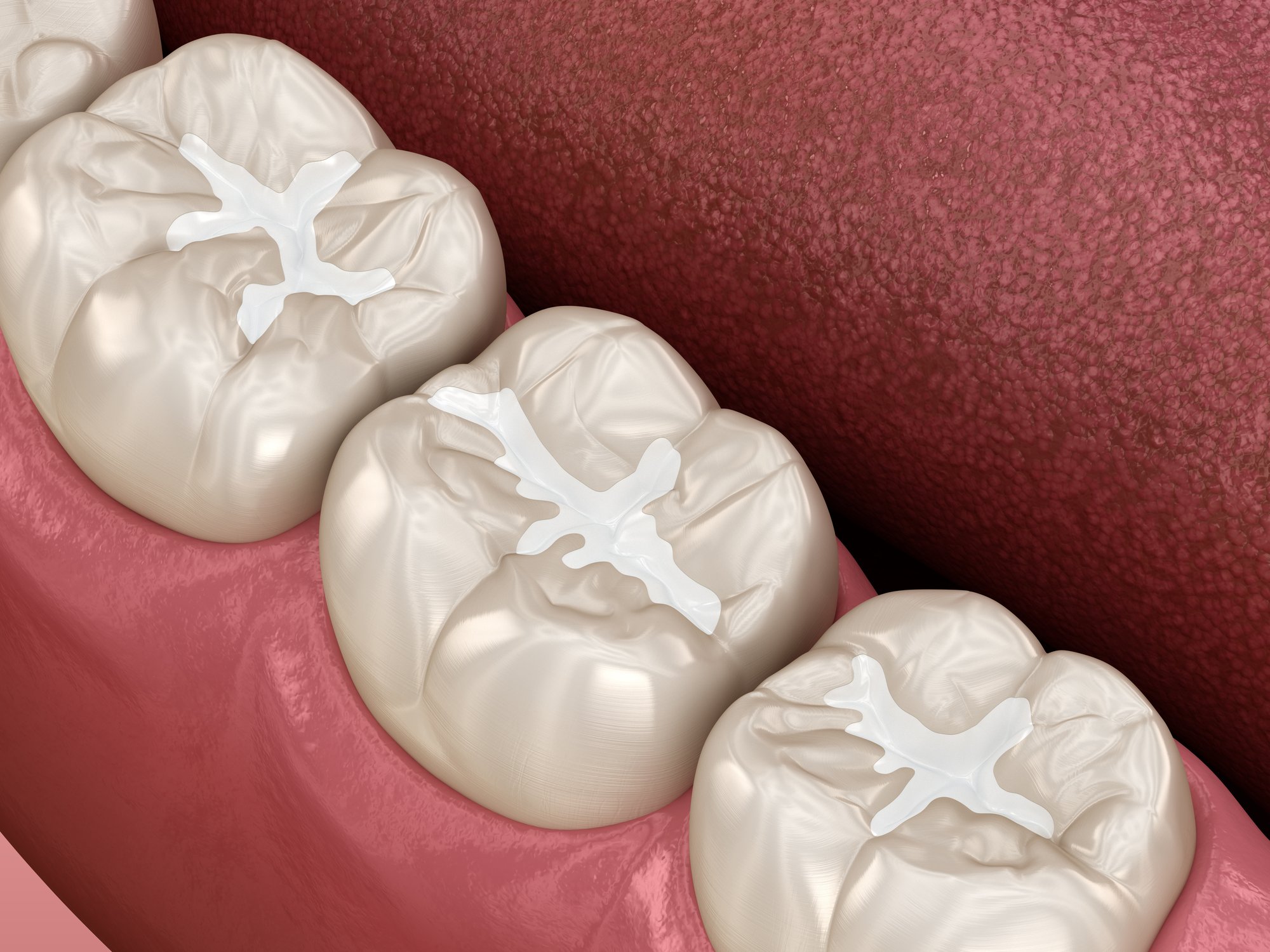 Are Dental Sealants for Kids Only or Can Adults Get Them?