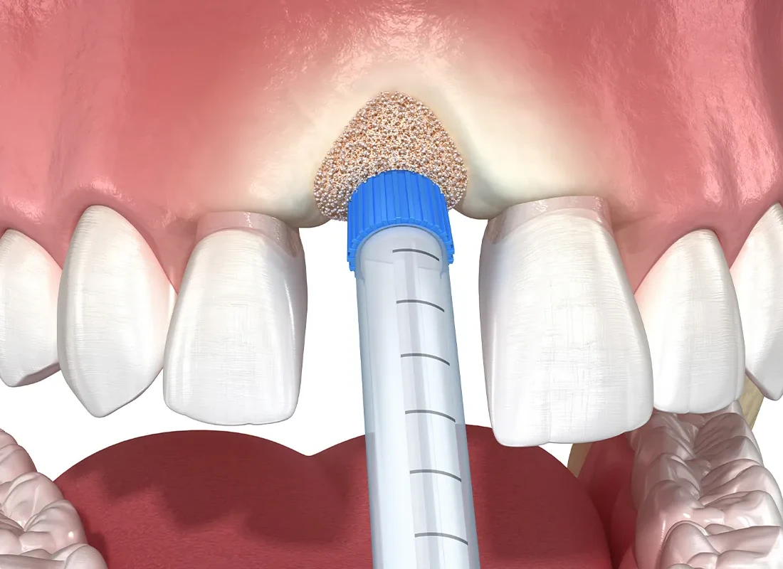 What is Sinus Lift Surgery