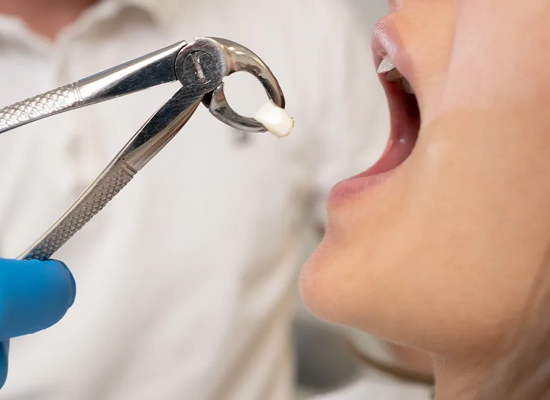 What is Tooth Extraction