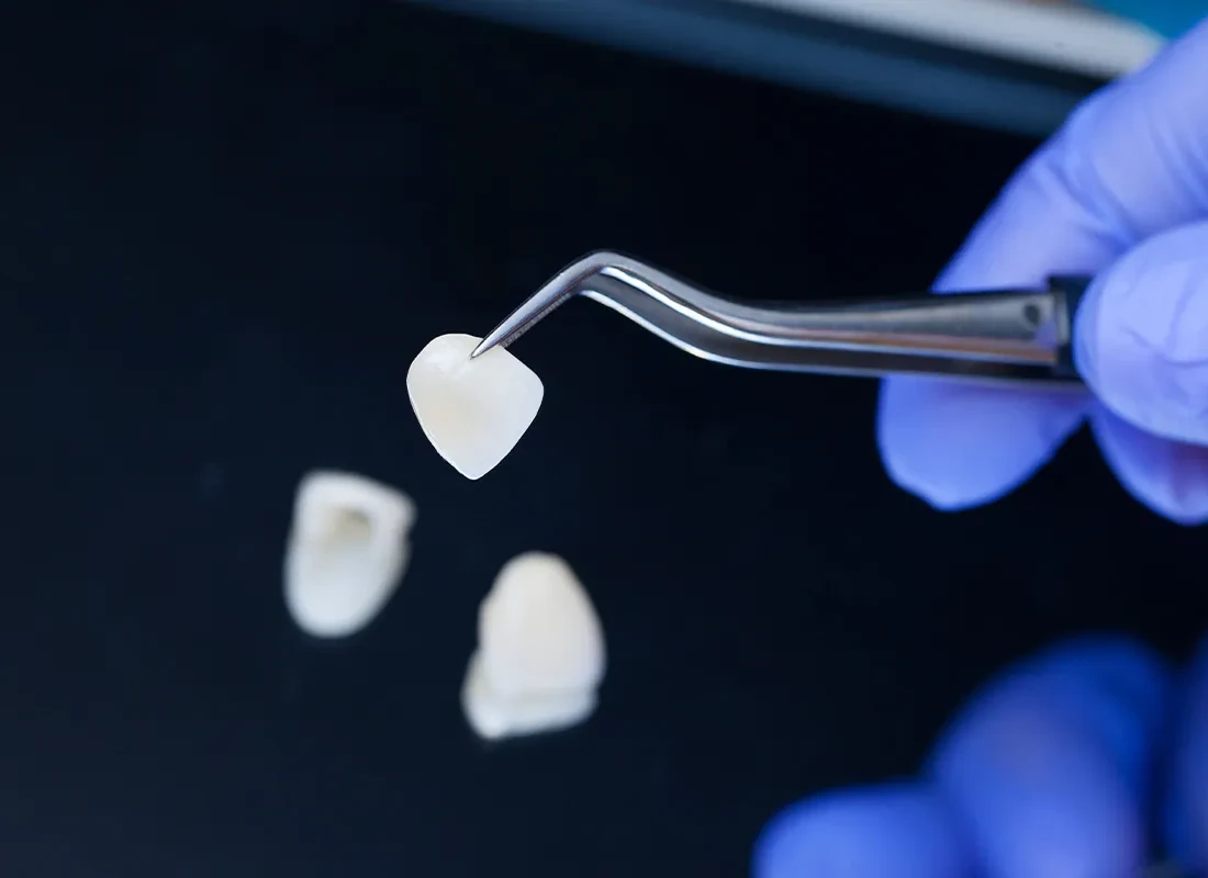 What is Dental Laminates