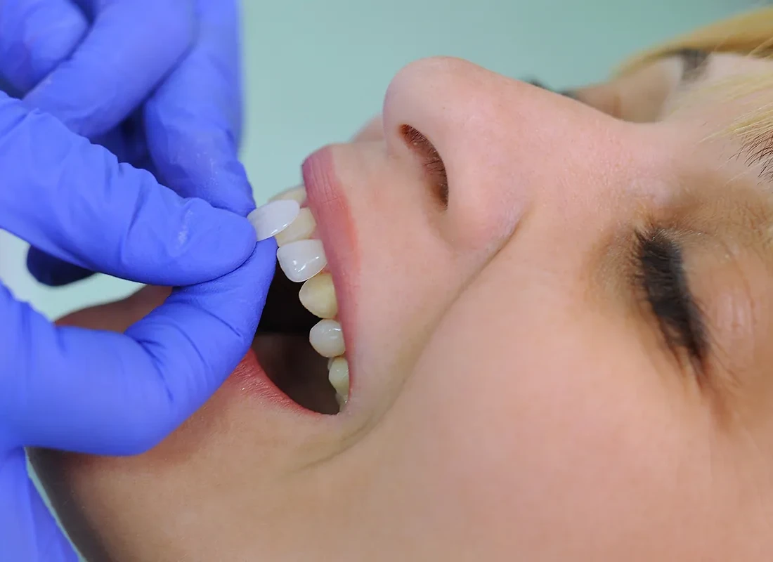 What is Porcelain Veneers